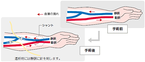 シャントとは?